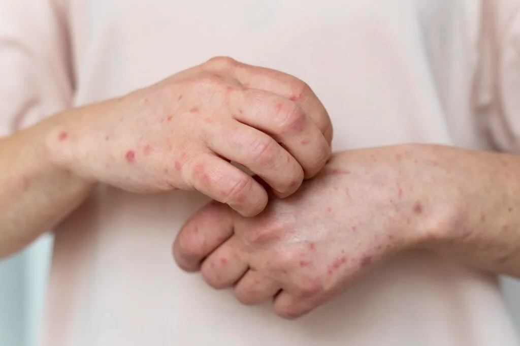 keratosis के उपचार के लिए डेरोबिन 
