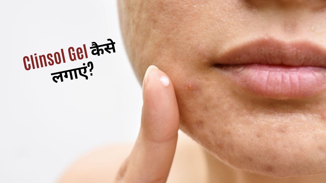 Clinsol Gel कैसे लगाएं?