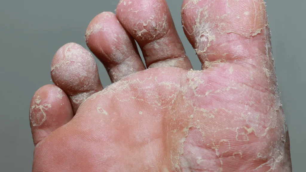 Athlete's Foot