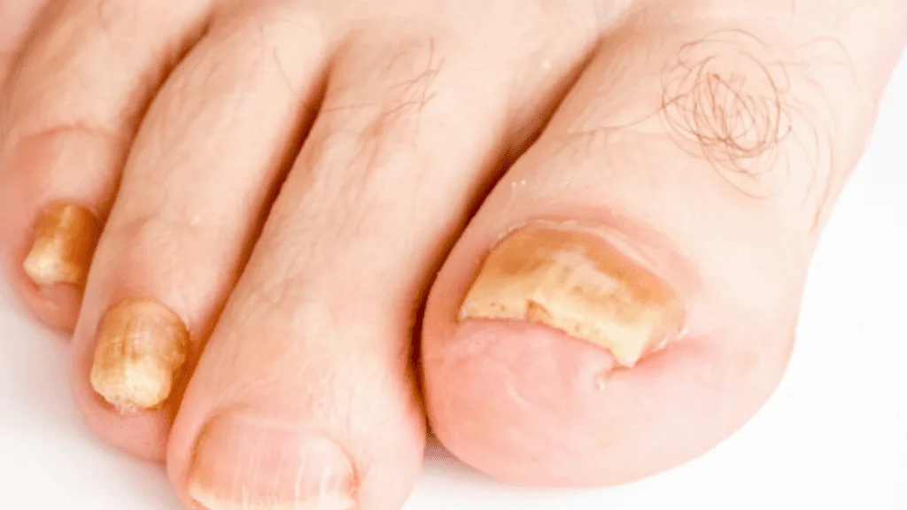 Onychomycosis