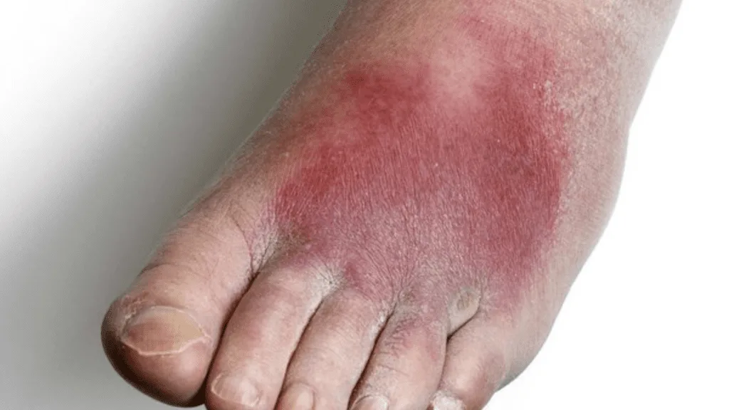 cellulitis 