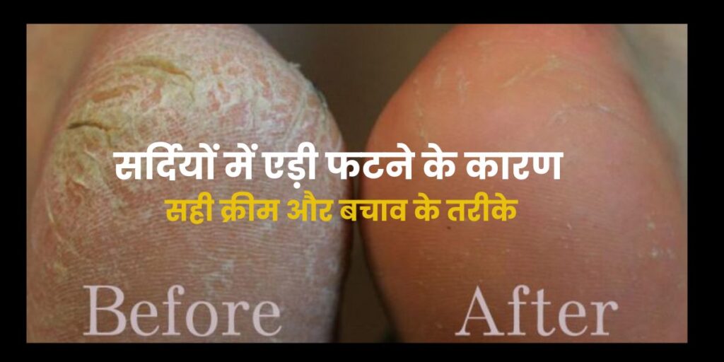 फटी एड़ियों का इलाज