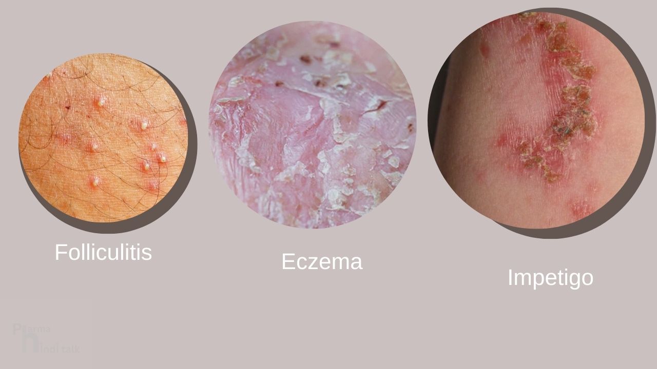 Bacterial skin diseases