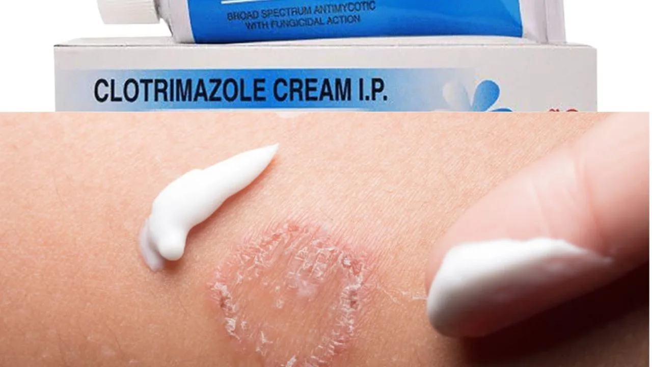 clotrimazole cream for fungal skin infection treatment